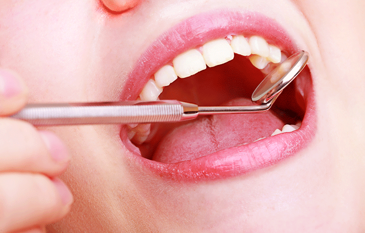 大切な歯を失わないための予防歯科